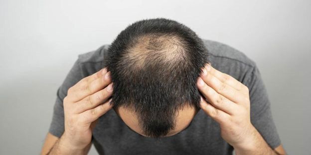 روش جدید درمان طاسی سر و افزایش تراکم مو