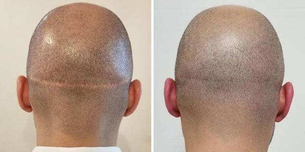 روش جدید درمان طاسی سر و افزایش تراکم مو